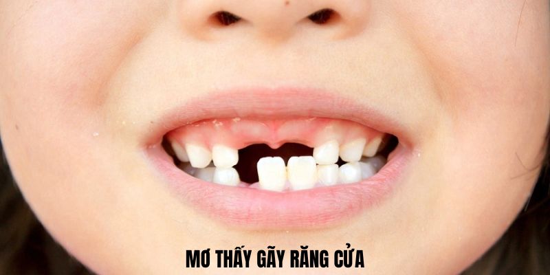 Mơ thấy gãy răng cửa